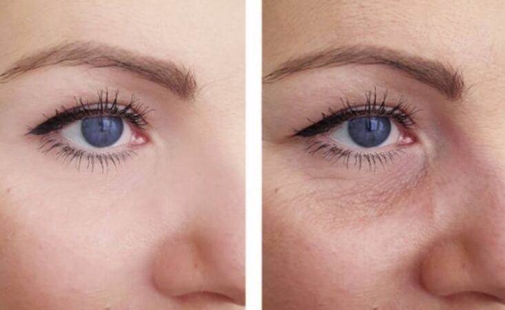 trước và sau khi trẻ hóa vùng quanh mắt bằng huyết tương