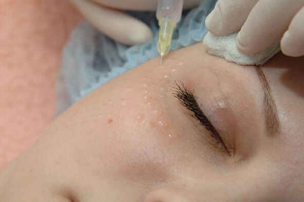 Mesotherapy - phương pháp tiêm trẻ hóa da mặt