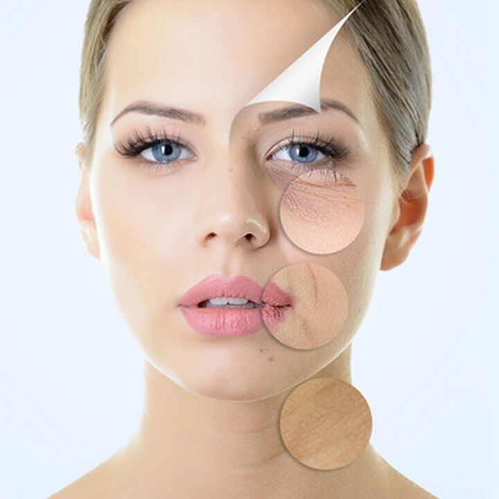 Những khiếm khuyết trên da mặt - chỉ định cho các liệu trình chống lão hóa