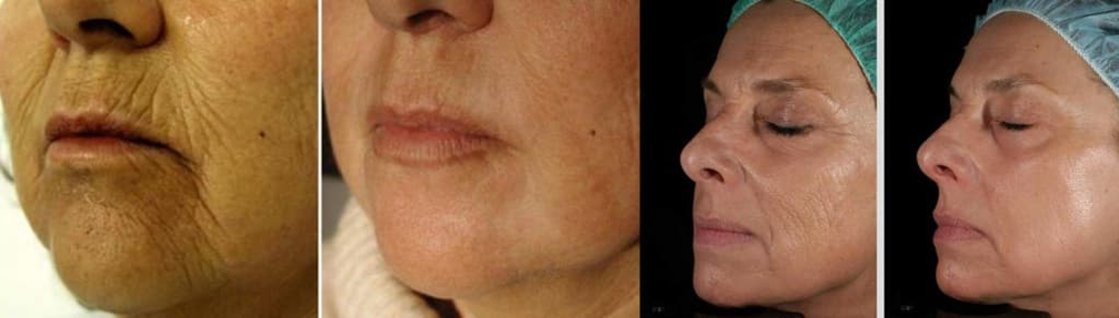 Da mặt trước và sau liệu trình trẻ hóa da bằng laser