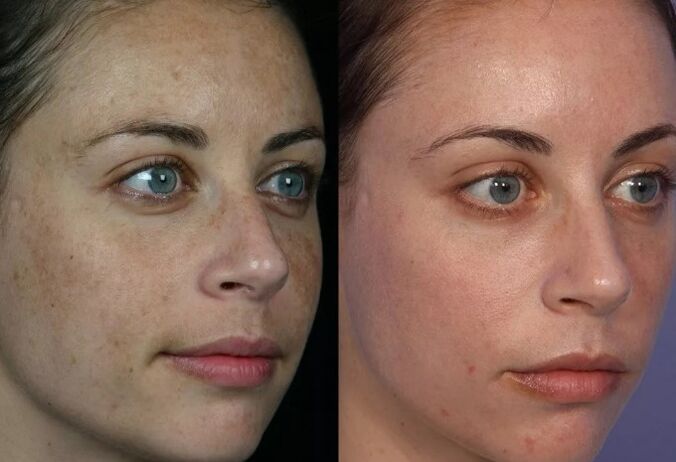Điều trị bằng da bằng laser
