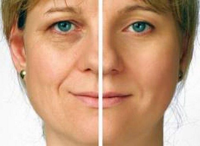 vùng da quanh mắt trước và sau khi trẻ hóa
