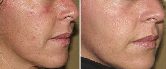 khuôn mặt trước và sau khi trẻ hóa da phần cứng